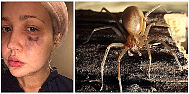 Meghan Linsey ကိုကိုက်စေတတ်သော Venomous Spider အကြောင်းသင်သိထားသင့်သည့်အချက်များ